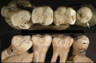 Models of damaged and decayed teeth